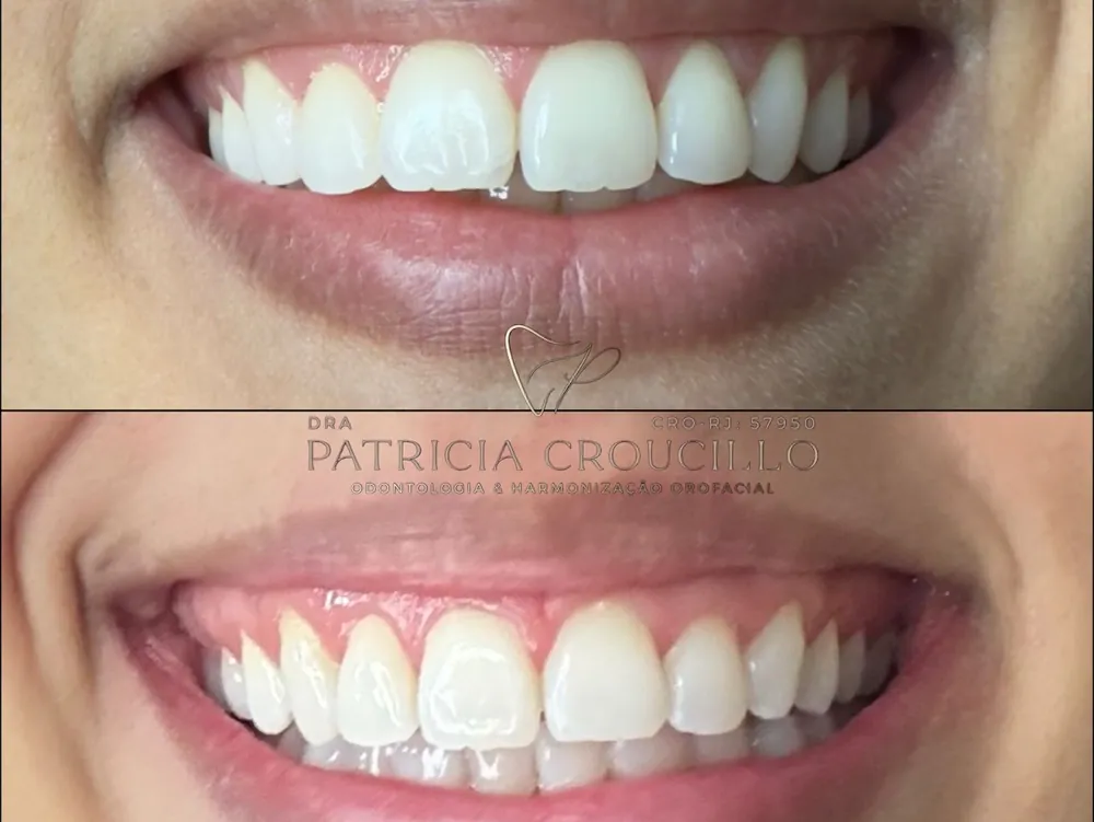 Comparação de antes e depois de tratamento estético dos dentes