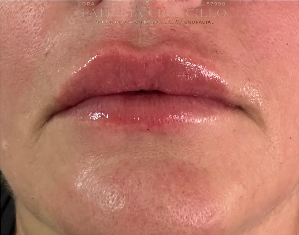 Lábios após procedimento de harmonização orofacial