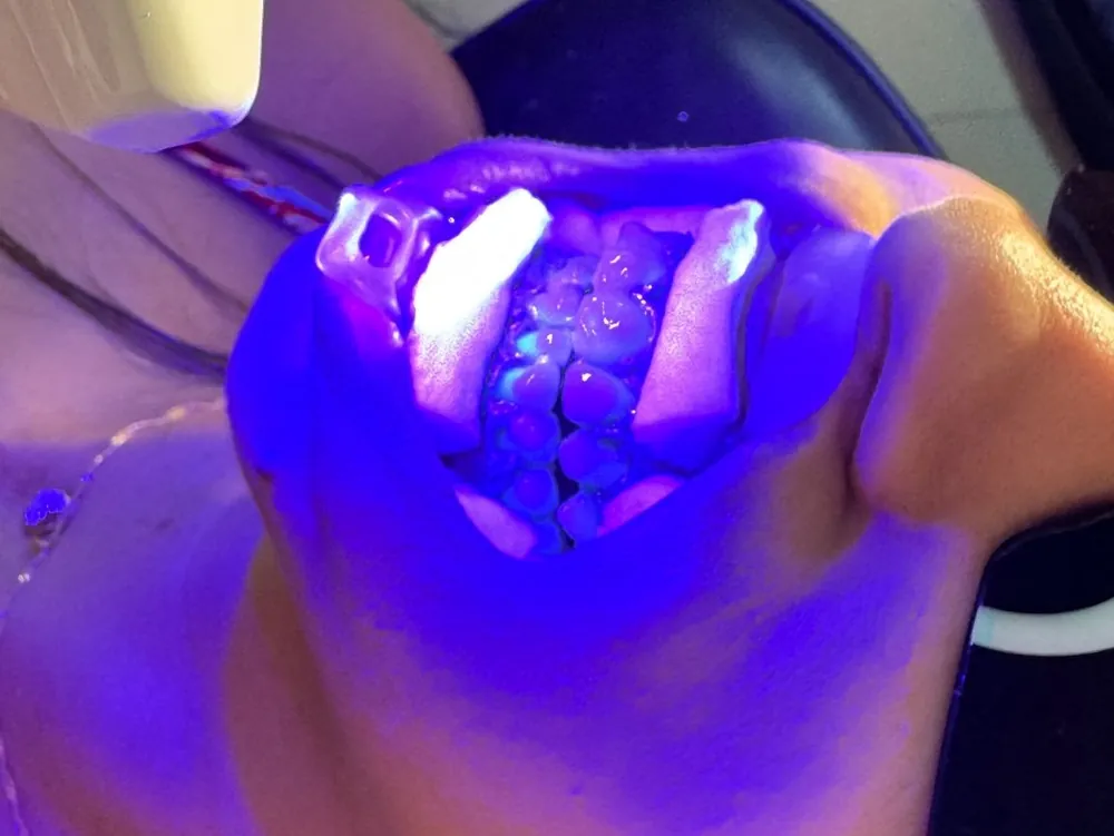 Procedimento odontológico com luz de fotopolimerização